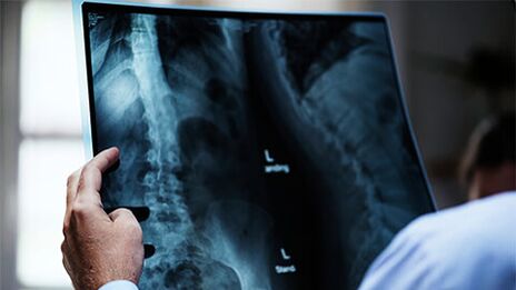 a gerinc széles körben elterjedt osteochondrosisa